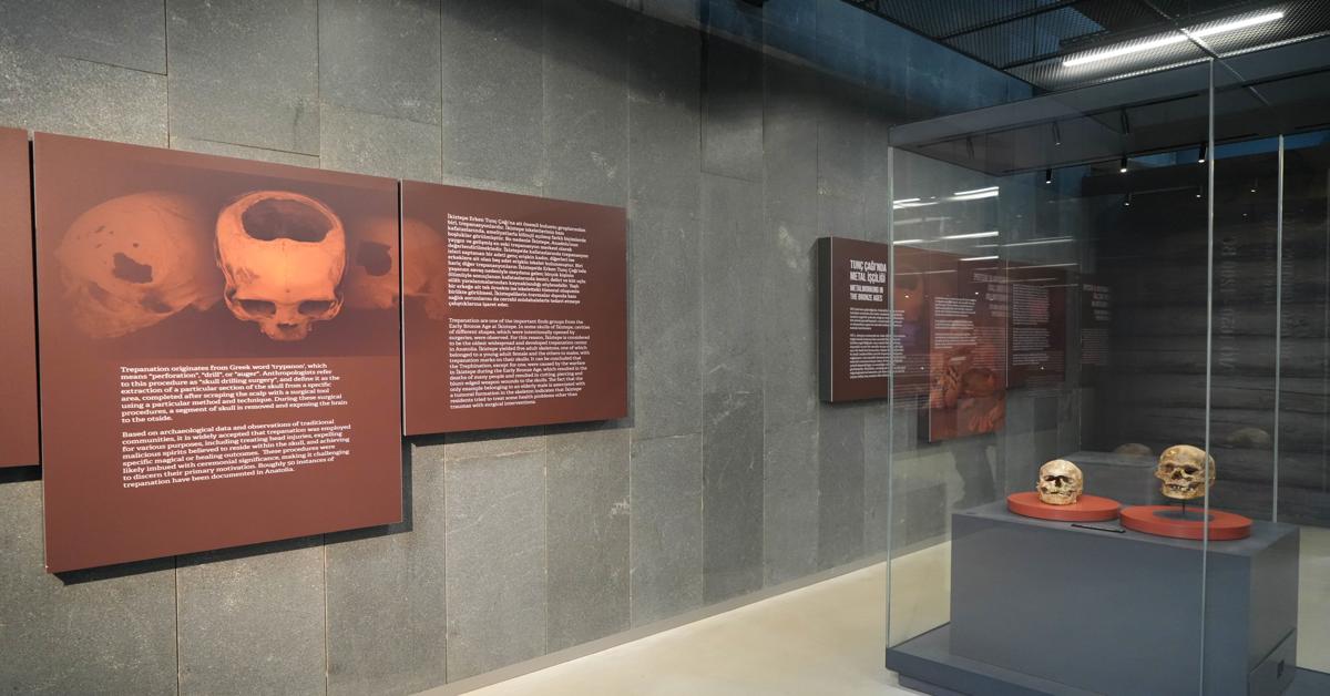 Anatolian skull operated on 5,000 years ago attracts attention