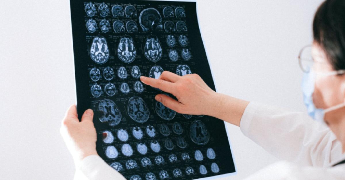 Blood proteins may predict dementia 10 years early, study finds