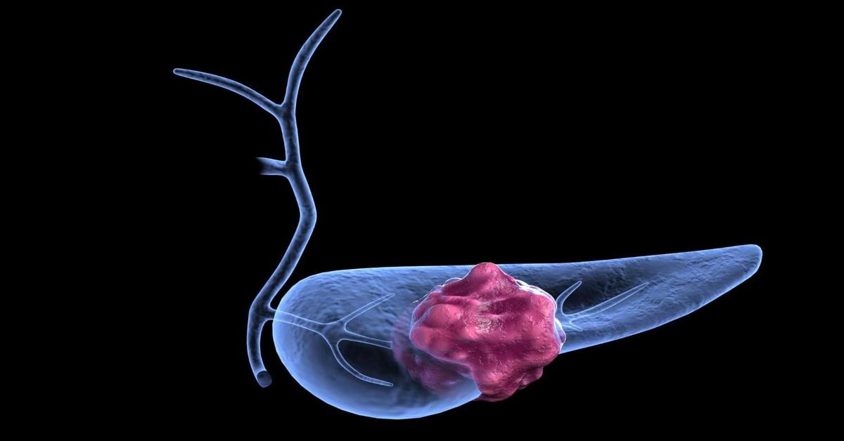 Researchers identify proteins linked to pancreatic cancer