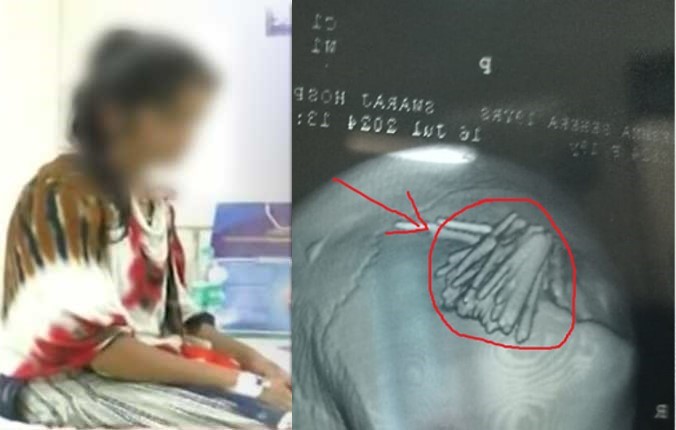 Indian woman undergoes surgery to remove 77 needles from skull, Odisha, India, July 19, 2024. (Courtesy of Odisha Bytes)