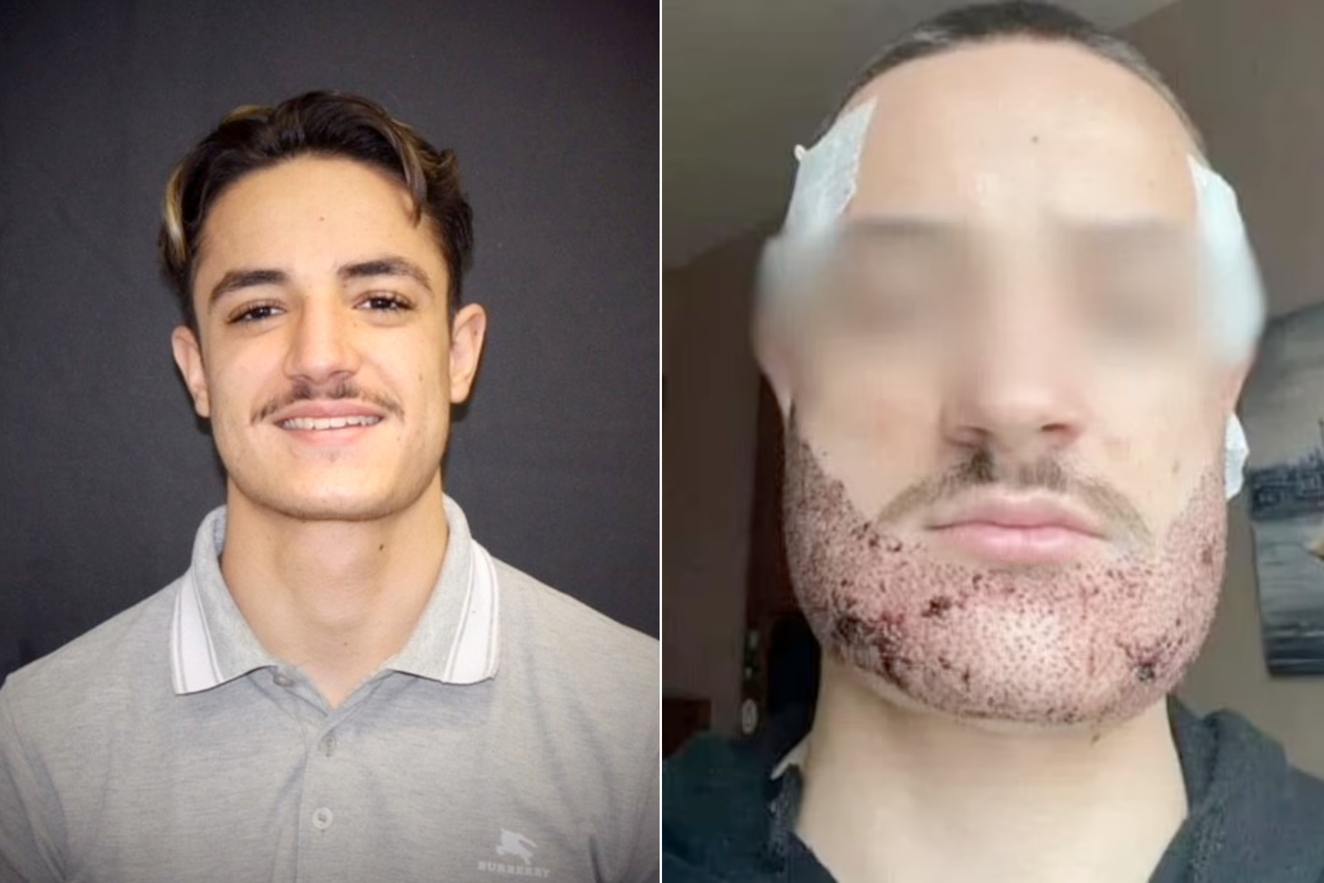 French student takes own life after beard transplant fiasco by Turkish real estate agent