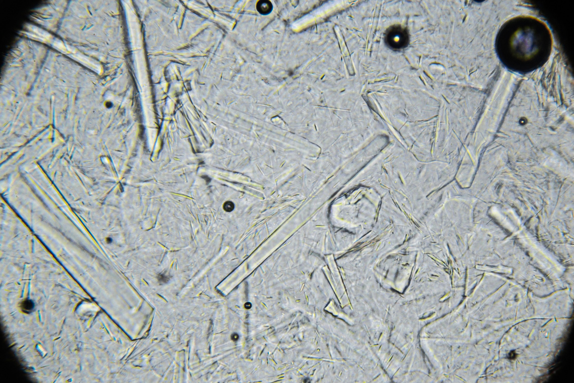 Artificial honey shows large rectangular sugar crystals under a microscope, low pollen count, and poor quality due to mixing with sugar syrup. (Adobe Stock Photo)