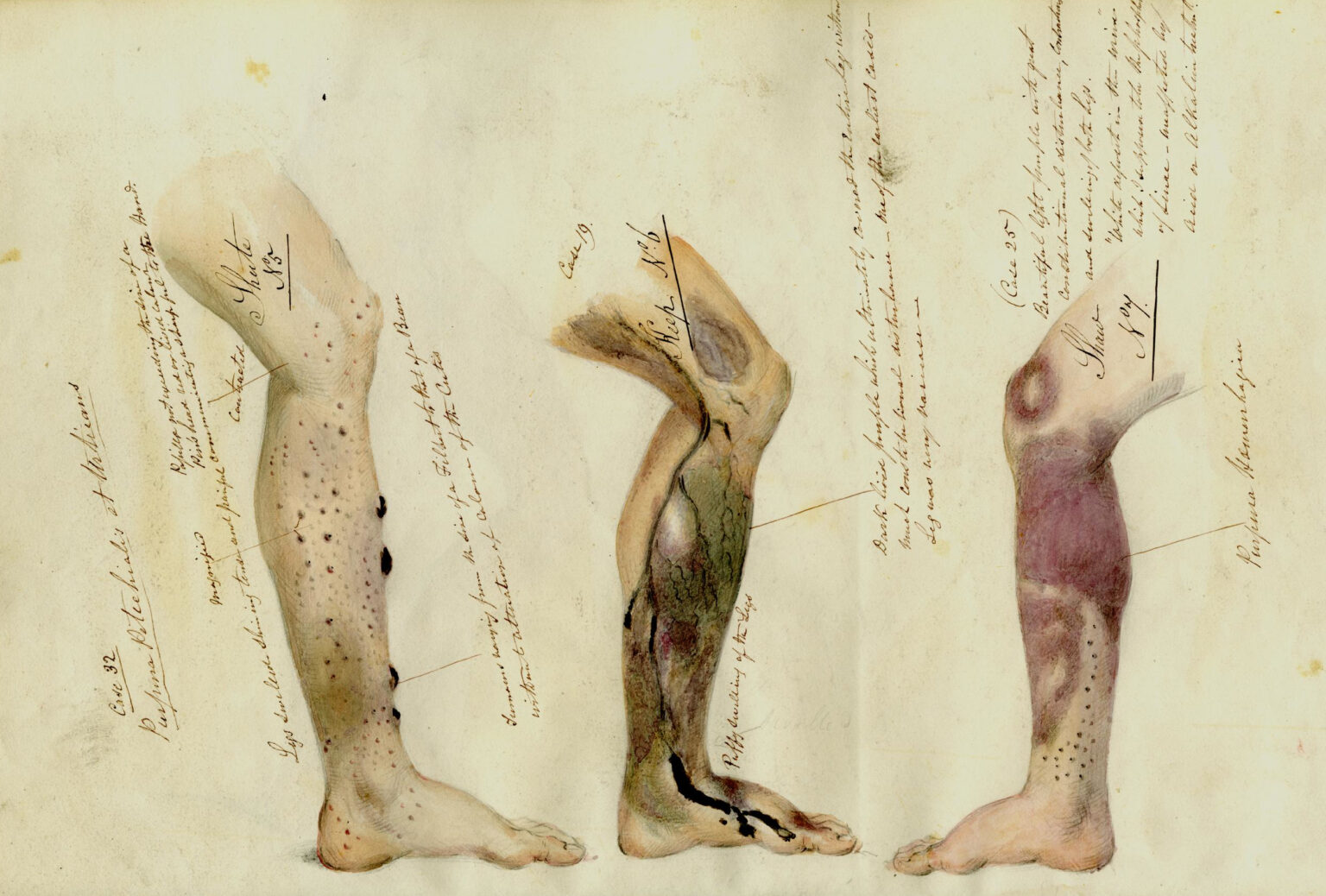 Watercolor illustrations of scurvy symptoms by Henry W. Mahon, a ship surgeon on the Barrosa, a British convict ship, ca. 1841. (Photo via The National Archives <a href=
