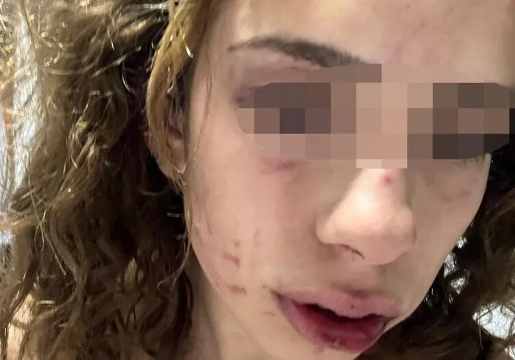 Turkish uni student brutally assaulted, suspect walks free under judicial control