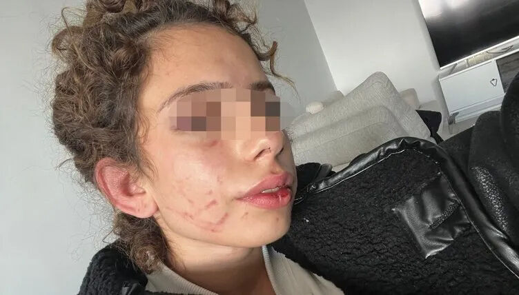 S.A. after the attack, sitting visibly battered and recalling the horrifying events, Konya, Türkiye, Nov. 27, 2024. (Türkiye Daily Photo)S.A.’s face shows extensive bruising and injuries from the assault, Konya, Türkiye, Nov. 27, 2024. (Türkiye Daily Photo)