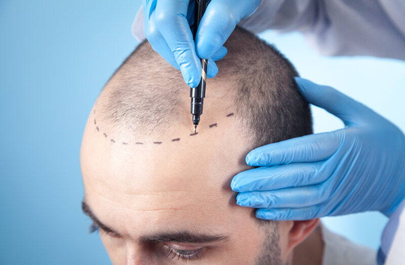 A patient prepares for a hair transplant procedure as Türkiye attracts more European clients with competitive prices. (Adobe Stock Photo)
