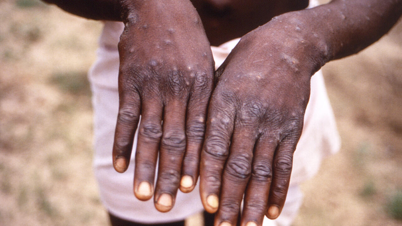 A person in DR Congo with a previous strain of mpox -- the new clade Ib is the 
