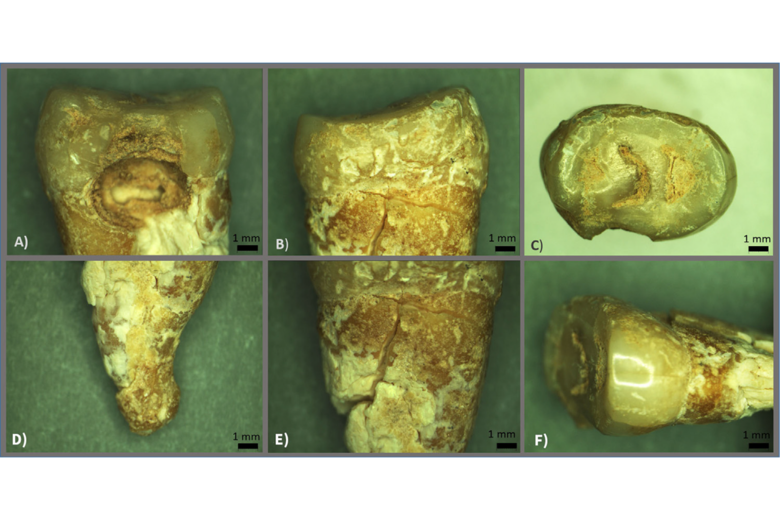 Microscopic images of an upper premolar tooth from the burial, showing decay and structural details, Israel, Mar. 3, 2025. (Courtesy of Matan Chocron, IAA)