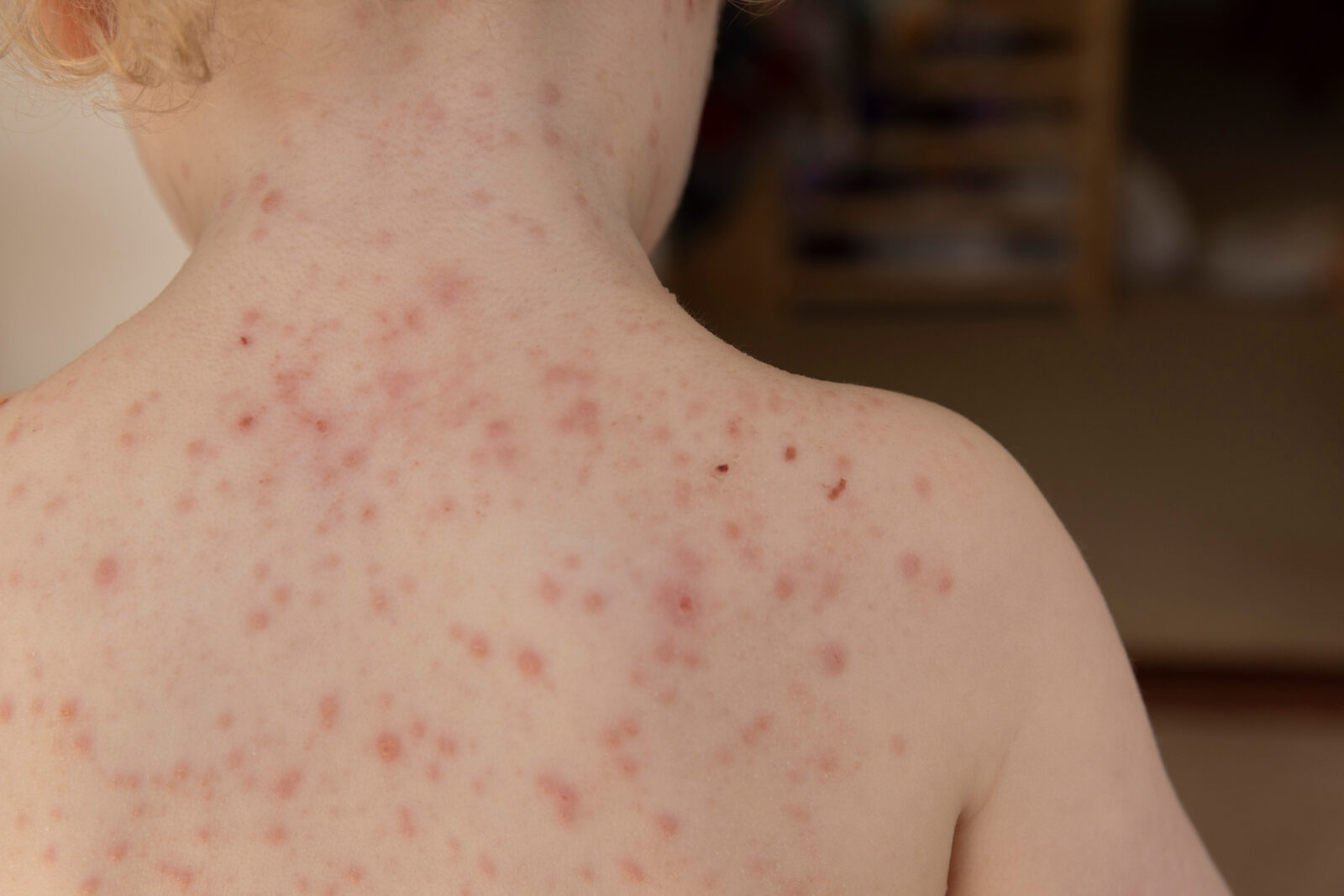 Back and shoulder acne revealing widespread inflammatory lesions across the upper back region, accessed on April 28, 2025. (Adobe Stock Photo)