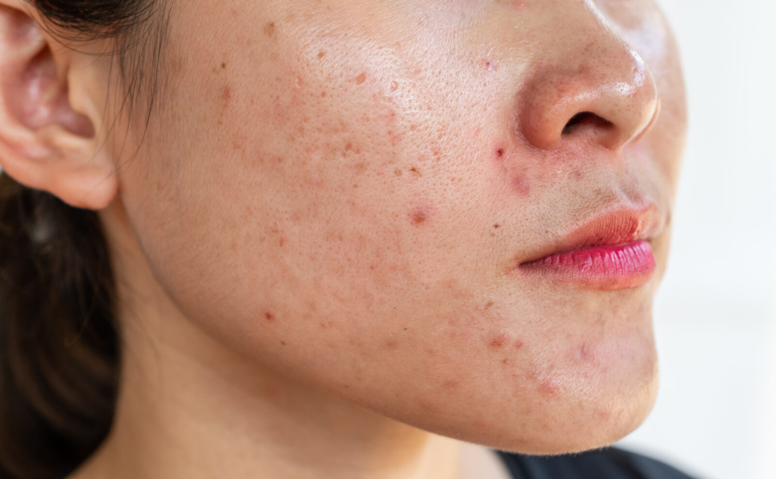 Close-up view of facial acne showing inflammation and various stages of blemishes on a person's cheek and jawline, accessed on April 28, 2025. (Adobe Stock Photo)