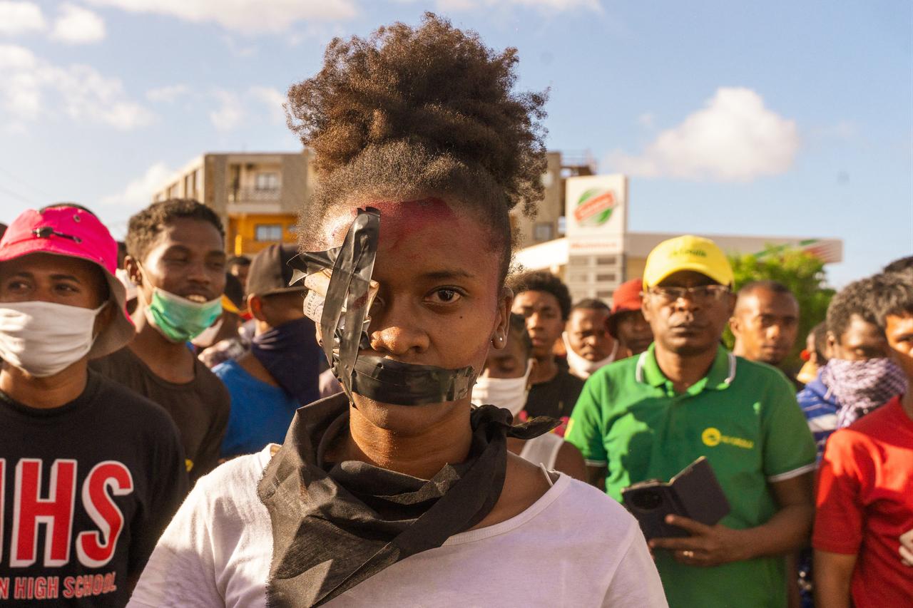 A protester wears tape over her mouth and one eye as they march during a protest calling for constitutional reforms and the resignation of President Andry Rajoelina in Antsiranana on October 10, 2025. (AFP Photo )