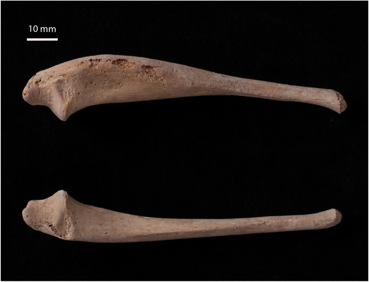 İnfantil kortikal hiperostozun (Caffey hastalığı) önemli bir göstergesi olan sol ulnar şaftın belirgin kalınlaşmasını gösteren sol ve sağ ulnanın karşılaştırılması. (Fotoğraf Duru Yağmur Başaran/Geçmişte Çocukluk)