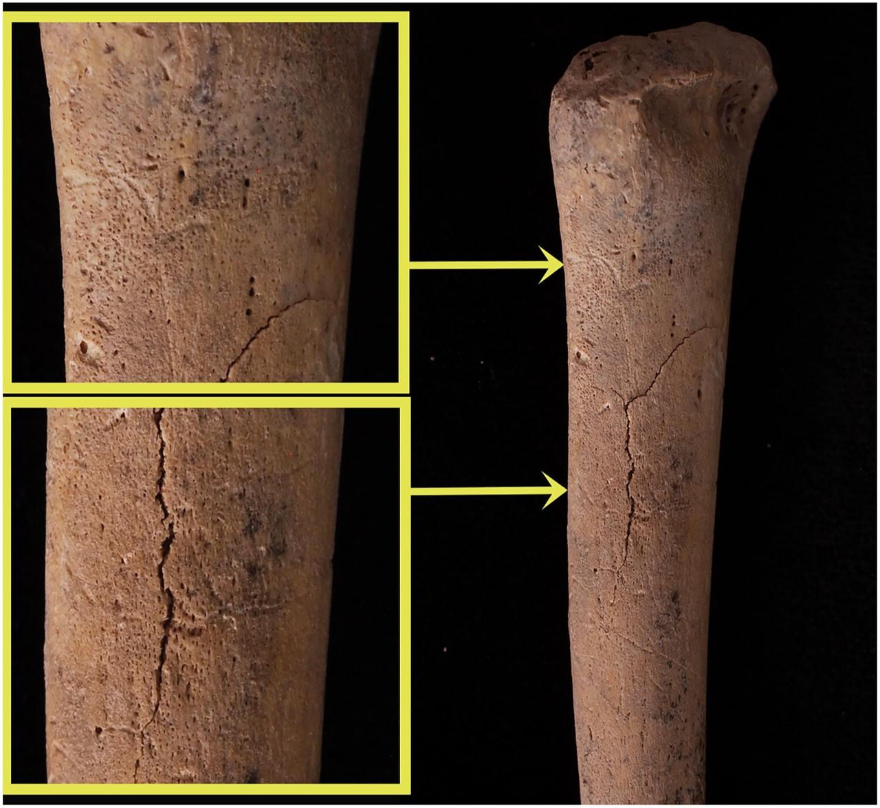 Sol humerus diyafizinde periosteal yeni kemiğin yeniden şekillenmesi, iltihaplanmayı ve ardından Caffey hastalığıyla uyumlu kemik rejenerasyonunu gösterir. (Fotoğraf Duru Yağmur Başaran/Geçmişte Çocukluk)