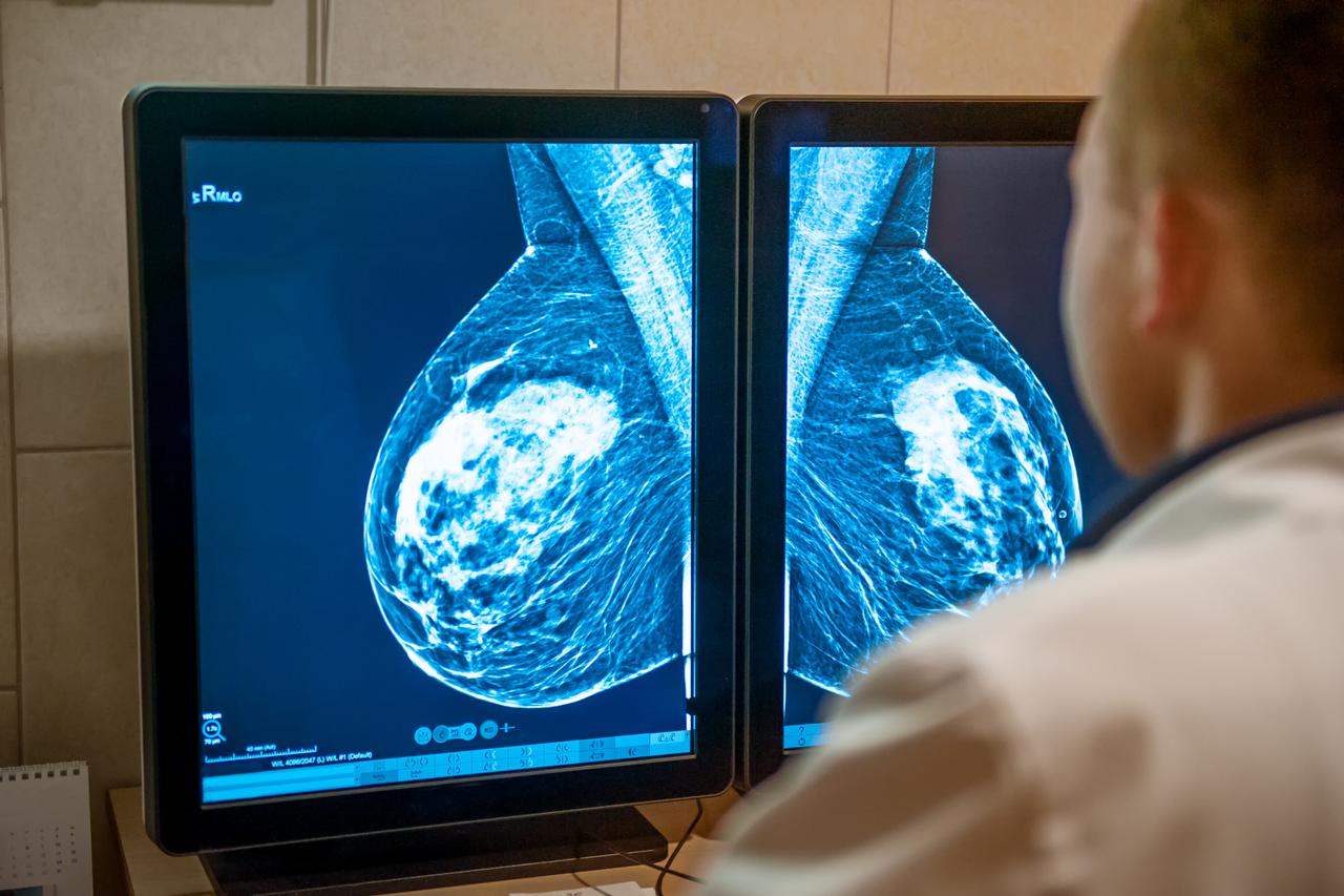 A doctor examines a mammogram image showing signs of possible breast abnormalities on dual monitors during a screening procedure. (Aobe Stock Photo)