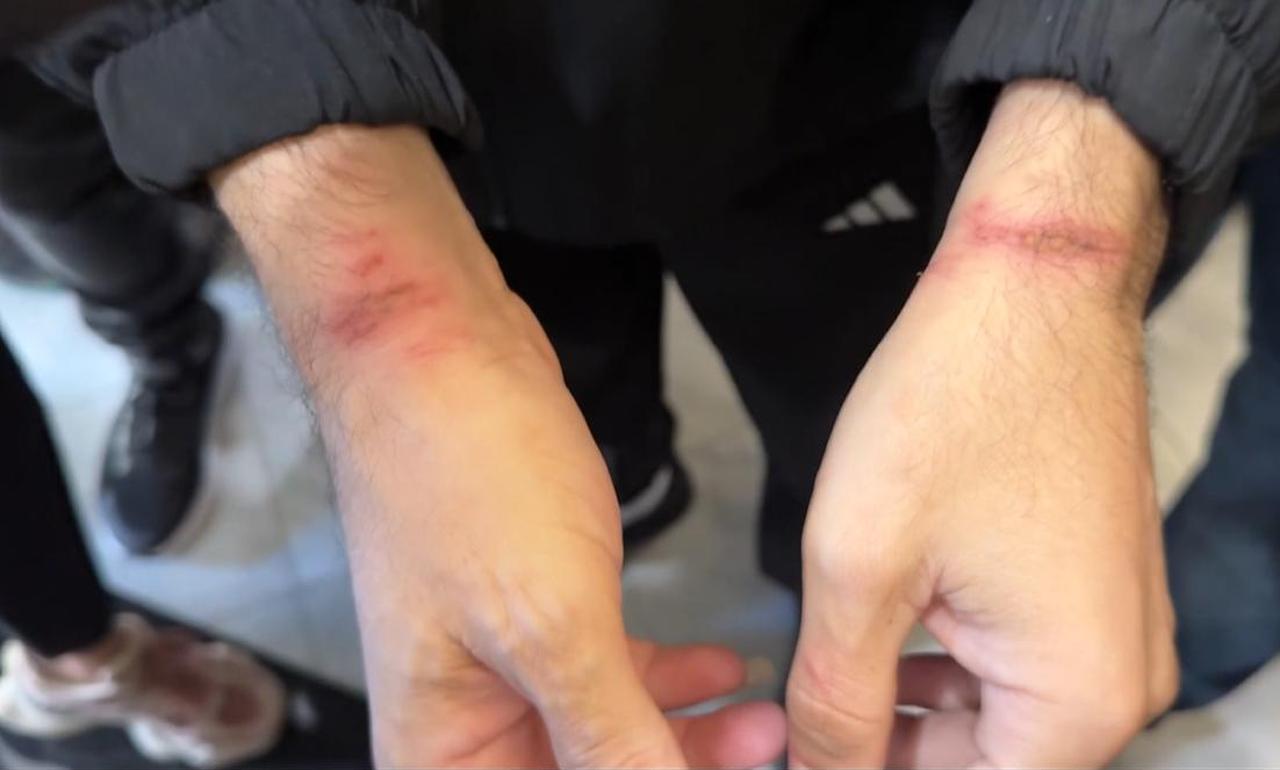 Signs of abuse on a Palestinian detainee, Kamal Abu Shanab, who was released from an Israeli prison , October 14, 2025. ( AA Photo )