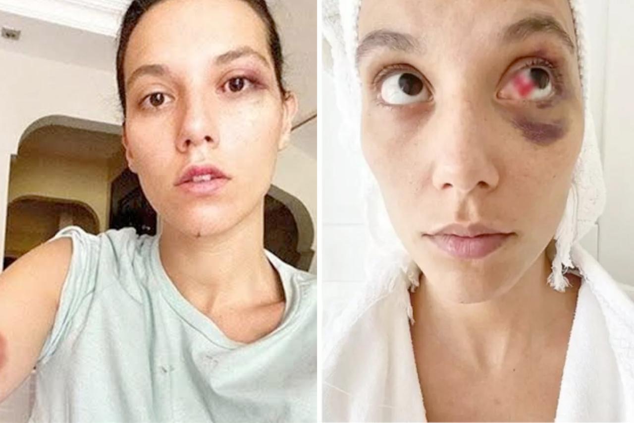 Photos of Deniz Bulutsuz circulated on social media in connection with the 2020 assault case involving actor Ozan Guven, accessed October 23, 2025. (Photo via X)
