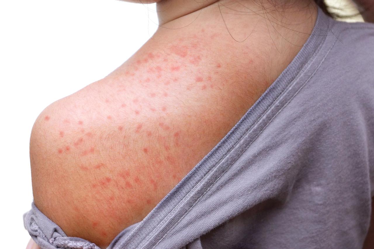 Child with measles rash. (Adobe Stock Photo)