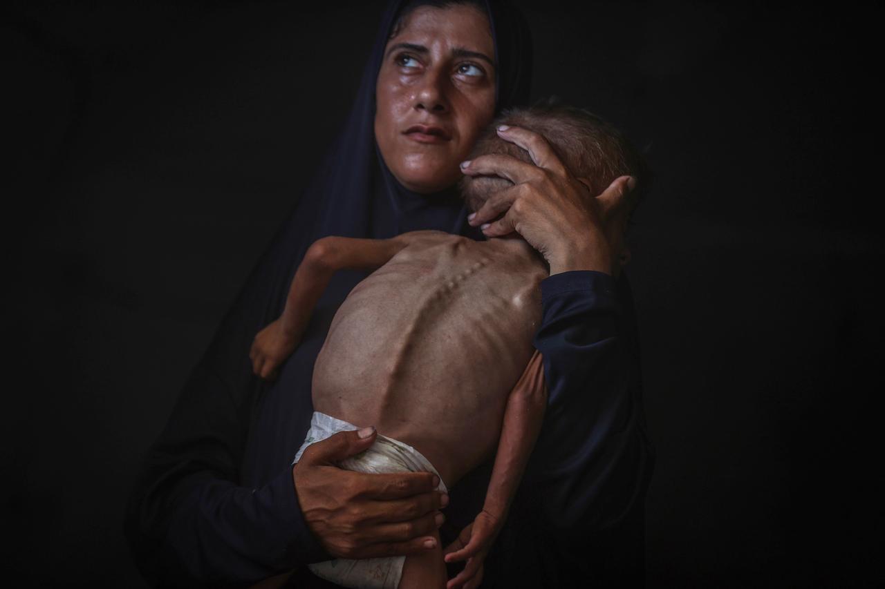 One-and-a-half-year-old Muhammed Zakariya Ayyub al-Matouk, one of thousands of children suffering from hunger and malnutrition in Gaza, faces life-threatening conditions due to Israel's ongoing attacks and blockade in Gaza City, Gaza on July 24, 2025.  (AA Photo)
