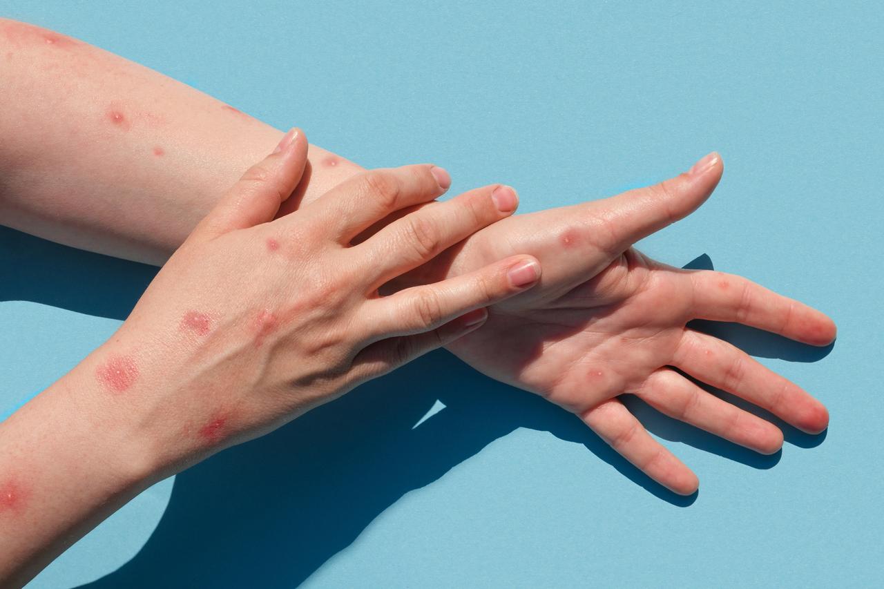 A patient with monkeypox is experiencing a painful rash, featuring red spots and blisters on their hand. (Adobe Stock Photo)