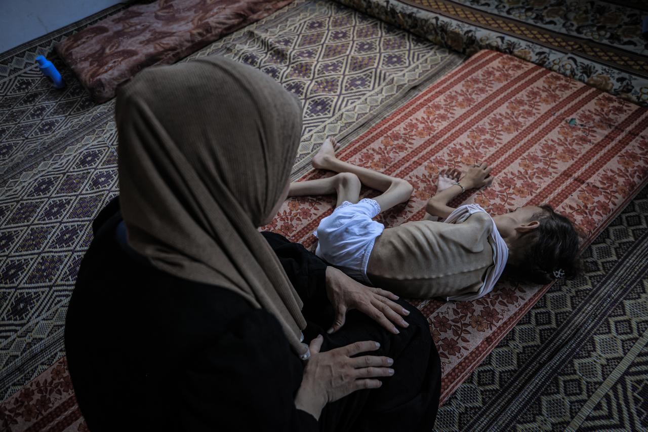 9 years-old Maryam Abdulaziz Mahmoud Davvas has become unable to walk due to severe malnutrition in Gaza City, Gaza on July 31, 2025. (AA Photo)