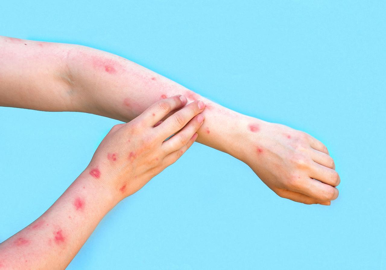 Patient with monkeypox showing a painful rash with red spots and blisters on the hand. (Adobe Stock Photo)