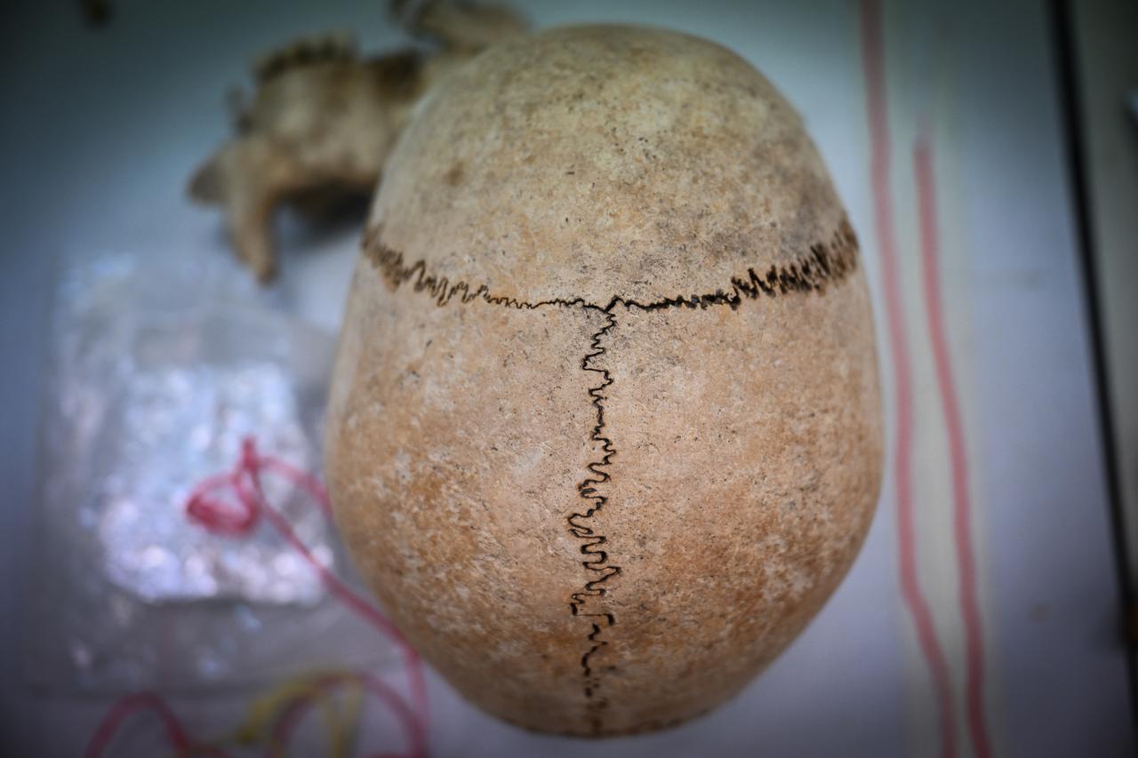 A human skull excavated from Cayonu Hill is seen during laboratory documentation at Hacettepe University in Ankara, Türkiye, Jan. 5, 2026. (AA Photo)
