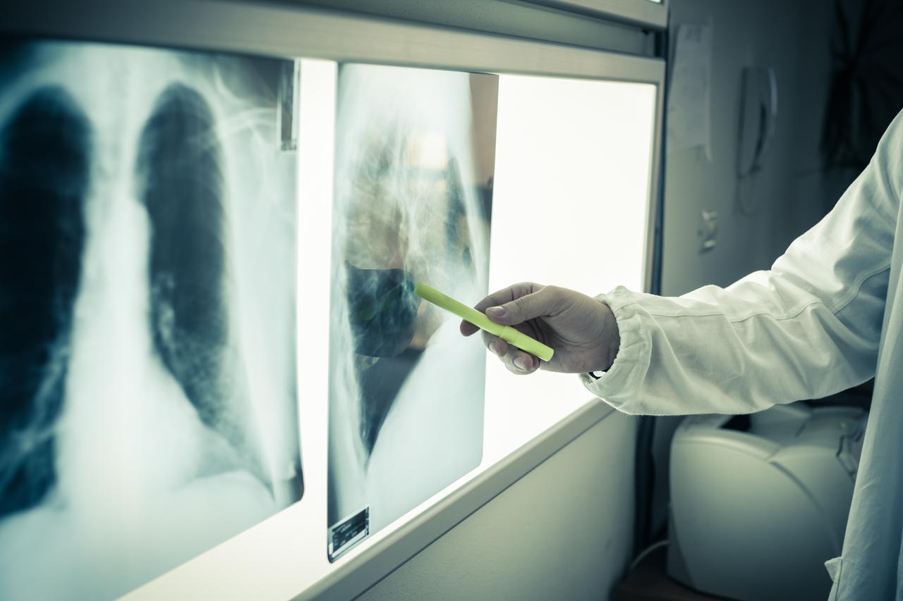 A medical professional examines chest X-ray images on an illuminated viewing panel. (Adobe Stock Photo)