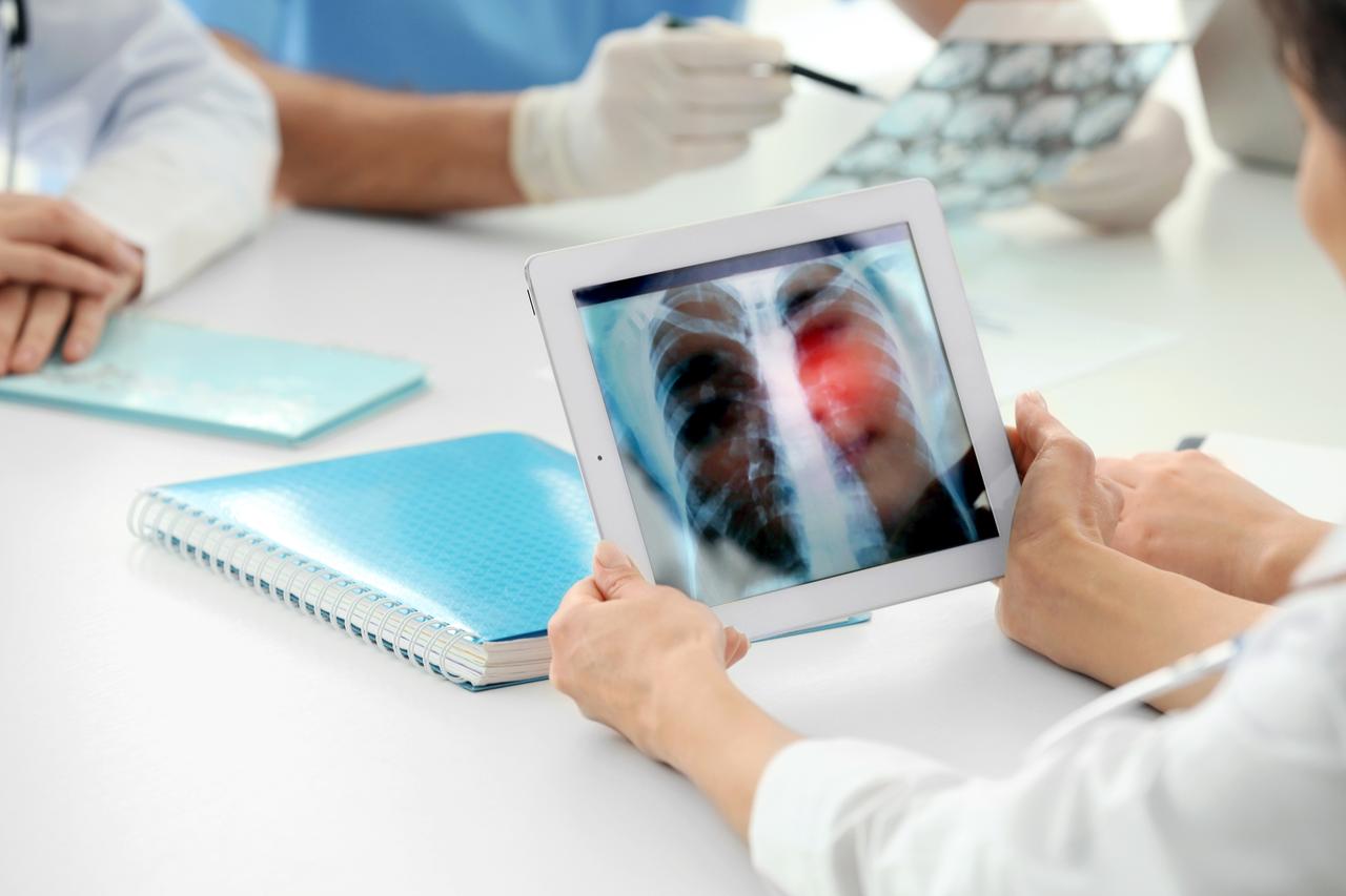 Lung and cervical cancer gaps leave 30,000 excess cases in EU