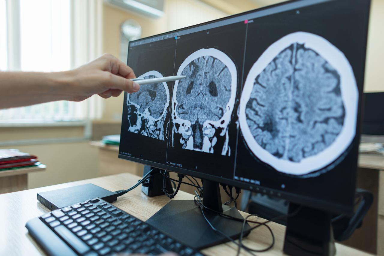 A medical professional examines brain scans displayed on a computer monitor. (Adobe Stock Photo)