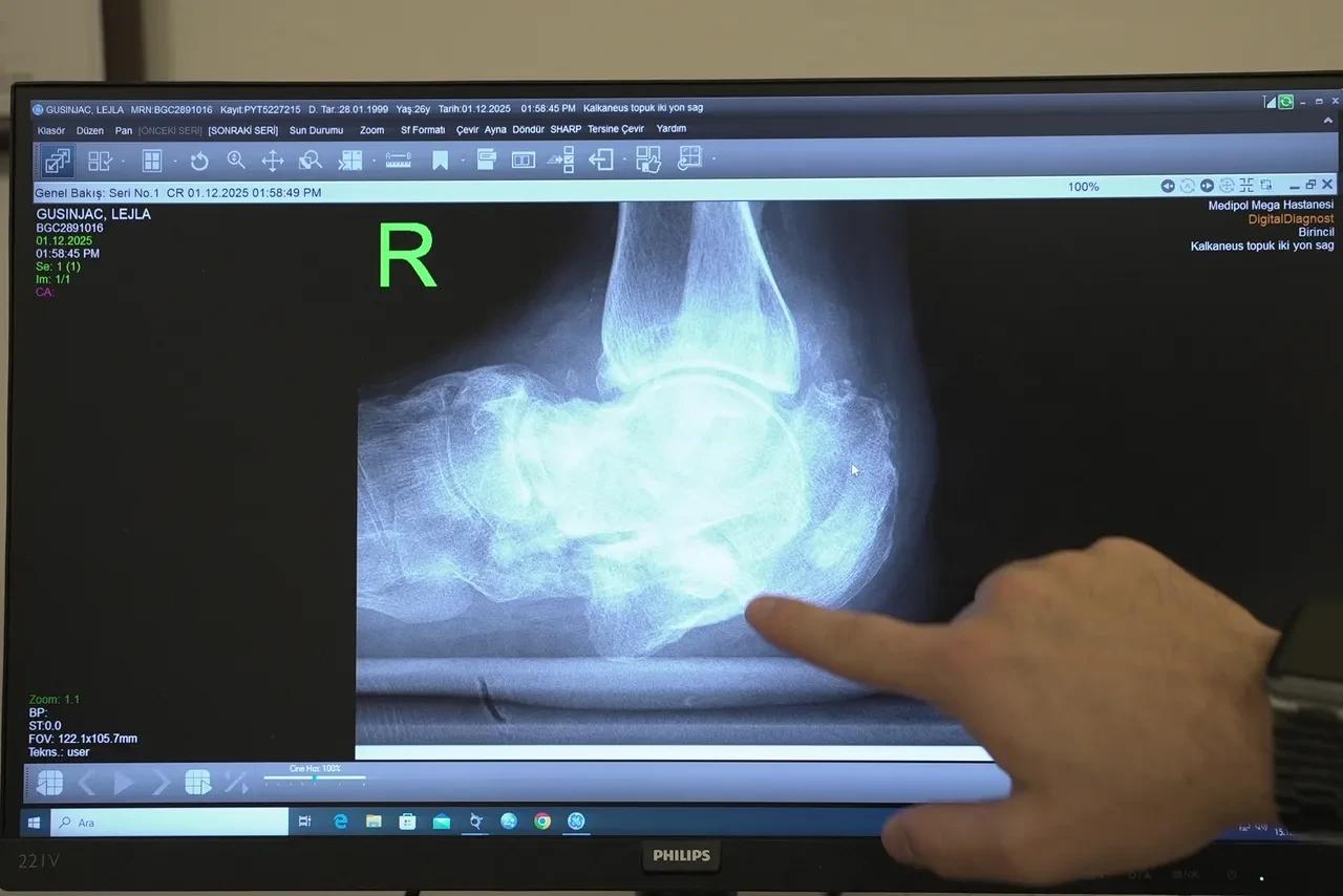 An X ray image shows the severe calcaneus fracture in Lejla Gusinjac’s heel, Istanbul, Türkiye, February 26, 2026. (TGRT Photo)