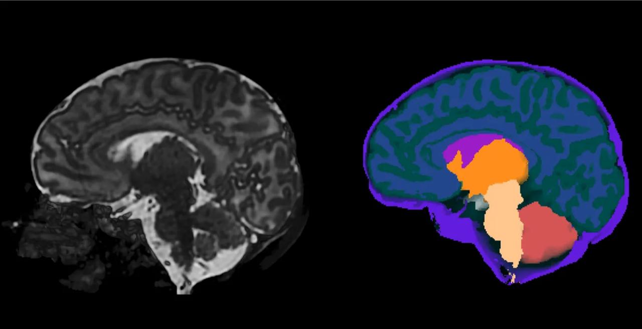 High-resolution neonatal brain MRI from the Developing Human Connectome Project, alongside a processed image segmenting different types of intracranial tissue. (Image via King's College London)