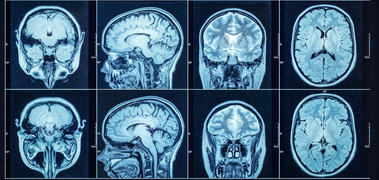 Close up of a MRI scan of a brain. (Adobe Stock Photo)