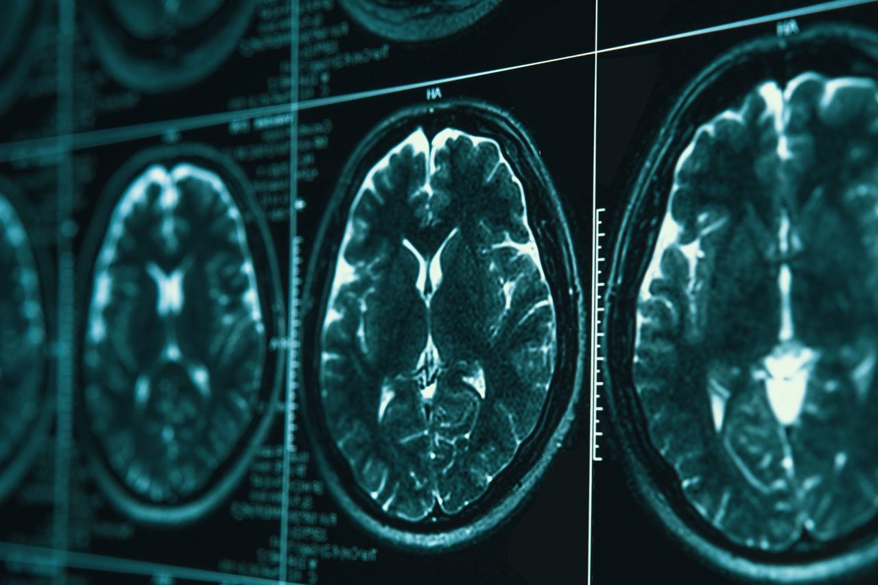 Alzheimer’s study finds one protein may hold key to brain’s cleanup system