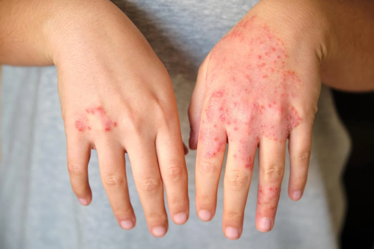 Bangladesh measles death toll rises to 873