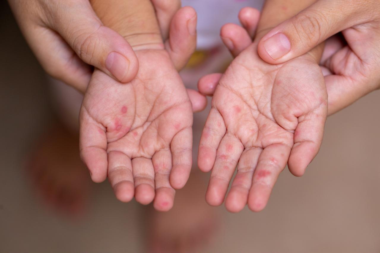 Measles deaths near 1,000 among children in Bangladesh as cases surge