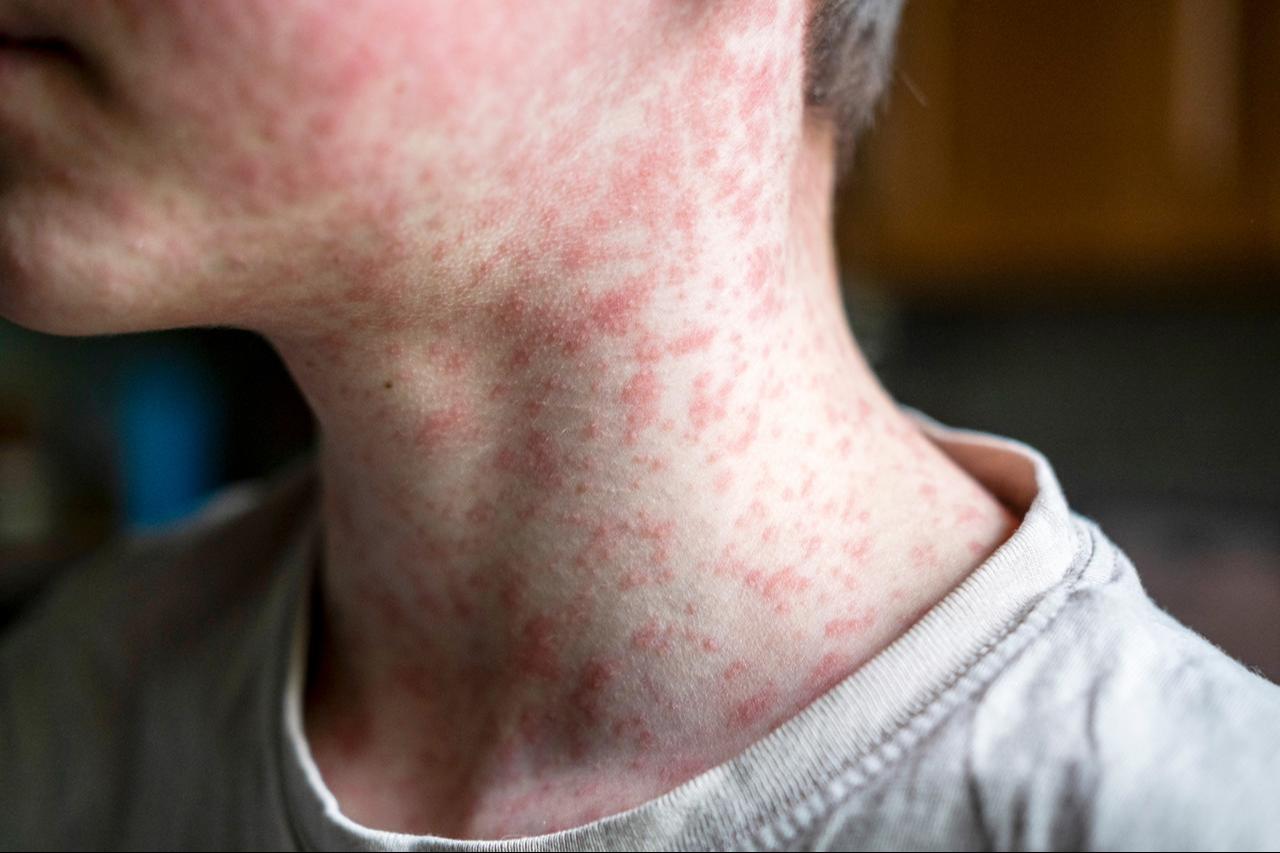 Health workers administer measles vaccines as WHO warns of record outbreaks in Europe and Central Asia in 2024 amid declining vaccination rates. (Adobe Stock Photo)