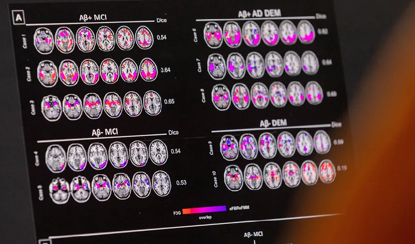 Blood proteins may predict dementia 10 years early, study finds