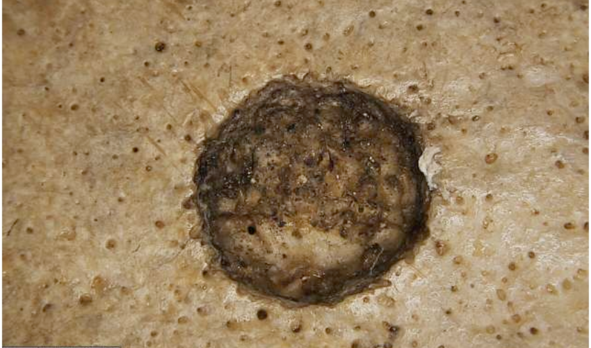 Recent study shows ancient Egyptians' efforts to treat cancer 4,000 years ago