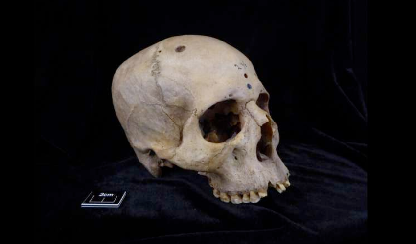 Recent study shows ancient Egyptians' efforts to treat cancer 4,000 years ago