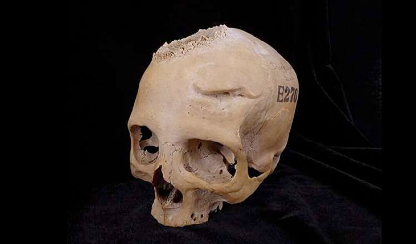 Recent study shows ancient Egyptians' efforts to treat cancer 4,000 years ago